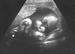 Normal_normal_echo_foetus