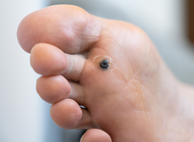 Normal_closeup-of-wart-plantar-after-cauterizing-it-with-2023-11-27-05-36-58-utc