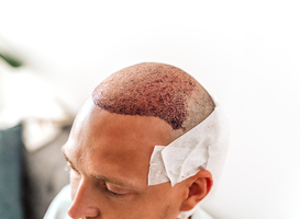 Normal_after-hair-transplantation-surgical-technique-that-2023-11-27-05-12-40-utc